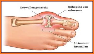 jicht artikel